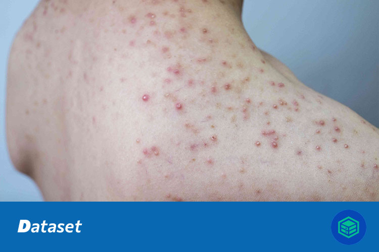 皮肤病图像分类数据集