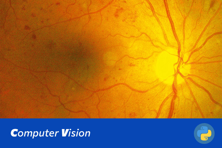 基于Swin Transformer的糖尿病视网膜病变影像分类与诊断系统